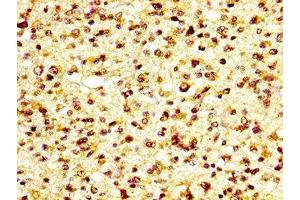IHC image of ABIN7163593 diluted at 1:600 and staining in paraffin-embedded human glioma performed on a Leica BondTM system. (GP6 anticorps  (AA 115-265))