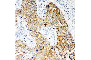 Anti-NOX5 antibody, IHC(P) IHC(P): Human Mammary Cancer Tissue