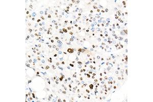 Immunohistochemistry of paraffin-embedded Human liver cancer using Cyclin E1 antibody (ABIN7266564) at dilution of 1:100 (40x lens).