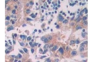 DAB staining on IHC-P; Samples: Human Prostate cancer Tissue (Tyrosine Protein Kinase 7 (AA 853-1070) anticorps)