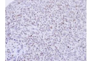 IHC-P Image Immunohistochemical analysis of paraffin-embedded H1299 xenograft , using PCNP, antibody at 1:500 dilution.