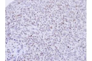 IHC-P Image Immunohistochemical analysis of paraffin-embedded H1299 xenograft , using PCNP, antibody at 1:500 dilution.