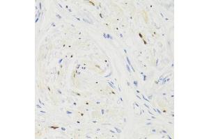Immunohistochemistry of paraffin-embedded human breast cancer using GEMIN2 Antibody (ABIN5971577) at dilution of 1/100 (40x lens). (SIP1 anticorps)