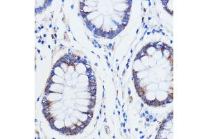 Immunohistochemistry of paraffin-embedded human colon carcinoma using TRIM16 antibody (ABIN7270978) at dilution of 1:100 (40x lens). (TRIM16 anticorps  (AA 1-210))