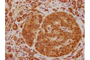 IHC image of ABIN7139763 diluted at 1:100 and staining in paraffin-embedded human pancreatic cancer performed on a Leica BondTM system.