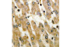 Immunohistochemical analysis of DUSP1/4 staining in human liver cancer formalin fixed paraffin embedded tissue section. (MKP-1/2 anticorps  (C-Term))