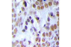 Immunohistochemical analysis of MCM3 staining in human breast cancer formalin fixed paraffin embedded tissue section.