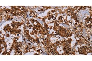 Immunohistochemistry of paraffin-embedded Human liver cancer using MOB1A Polyclonal Antibody at dilution of 1:30 (MOB1A anticorps)