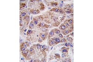 Formalin-fixed and paraffin-embedded human hepatocarcinoma tissue reacted with FDPS antibody (Center ) (ABIN389054 and ABIN2839263) , which was peroxidase-conjugated to the secondary antibody, followed by DAB staining. (FDPS anticorps  (AA 389-419))