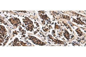 Immunohistochemistry of paraffin-embedded Human breast cancer tissue using ARPC1B Polyclonal Antibody at dilution of 1:65(x200) (ARPC1B anticorps)