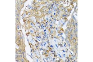 Immunohistochemistry of paraffin-embedded human lung cancer using R Rabbit mAb (ABIN7269840) at dilution of 1:100 (40x lens).