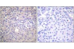 Immunohistochemistry analysis of paraffin-embedded human breast carcinoma, using IRS-1 (Phospho-Ser612) Antibody.