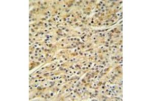 Immunohistochemistry analysis in formalin fixed and paraffin embedded prostate carcinoma reacted with HOXA3 / HOX1E Antibody (C-term) Cat. (HOXA3 anticorps  (C-Term))