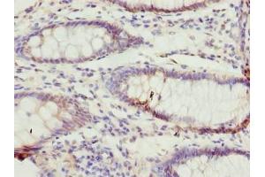 Immunohistochemistry of paraffin-embedded human colon cancer using ABIN7171939 at dilution of 1:100 (TTC38 anticorps  (AA 2-200))