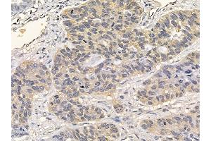 FGFR3 Mouse Monoclonal Antibody at 1/100 staining human lung cancer and adjacent non-tumor tissue by IHC-P. (FGFR3 anticorps  (C-Term))