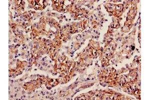 Immunohistochemistry of paraffin-embedded human lung cancer using ABIN7156215 at dilution of 1:100