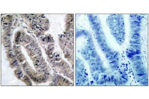 Immunohistochemical analysis of paraffin-embedded human colon carcinoma tissue using AMPKa1(Phospho-Ser487)Antibody(left) or the same antibody preincubated with blocking peptide(right).