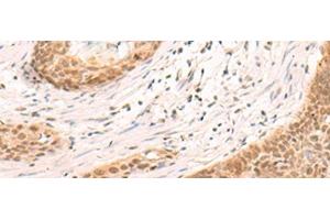 Immunohistochemistry of paraffin-embedded Human esophagus cancer tissue using SIX6 Polyclonal Antibody at dilution of 1:30(x200) (SIX Homeobox 6 anticorps)