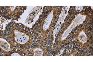 Immunohistochemistry of paraffin-embedded Human colon cancer using GOT2 Polyclonal Antibody at dilution of 1:50