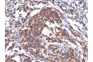 Formalin-fixed, paraffin-embedded human Melanoma stained with Vimentin Monoclonal Antibody (LN-6). (Vimentin anticorps)