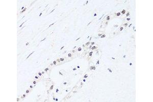 Immunohistochemistry of paraffin-embedded Human gastric cancer using BRIX1 Polyclonal Antibody at dilution of 1:100 (40x lens). (BRIX1 anticorps)