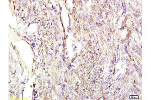Formalin-fixed and paraffin embedded human cervical carcinoma labeled with Anti-CGA/ Chromogranin A Polyclonal Antibody, Unconjugated (ABIN669846) at 1:200 followed by conjugation to the secondary antibody and DAB staining (Chromogranin A anticorps  (AA 420-457))
