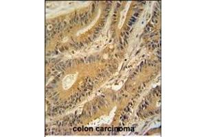 GNAT3 antibody (Center) (ABIN654441 and ABIN2844175) immunohistochemistry analysis in formalin fixed and paraffin embedded human colon carcinoma followed by peroxidase conjugation of the secondary antibody and DAB staining.