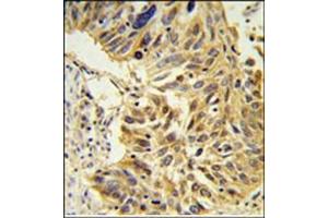 Immunohistochemistry analysis in Formalin Fixed, Paraffin Embedded lung carcinoma stained with SDR Antibody (Center) followed by peroxidase conjugation of the secondary antibody and DAB staining. (SDPR anticorps  (Middle Region))