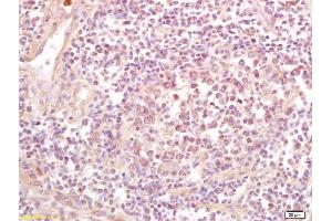 Formalin-fixed and paraffin embedded human lung carcinoma labeled with Rabbit Anti NDUFS1(75kD) Polyclonal Antibody, Unconjugated (ABIN750703) at 1:200 followed by conjugation to the secondary antibody and DAB staining