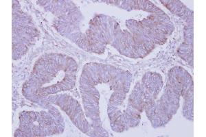 IHC-P Image Immunohistochemical analysis of paraffin-embedded human colon carcinoma, using PHKA2, antibody at 1:250 dilution. (PHKA2 anticorps  (C-Term))