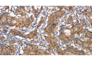 Immunohistochemistry of paraffin-embedded Human gastic cancer using CDC25A Polyclonal Antibody at dilution of 1:50 (CDC25A anticorps)
