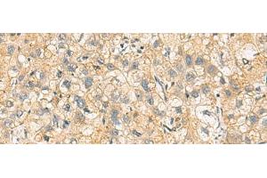 Immunohistochemistry of paraffin-embedded Human liver cancer tissue using NANP Polyclonal Antibody at dilution of 1:65(x200)