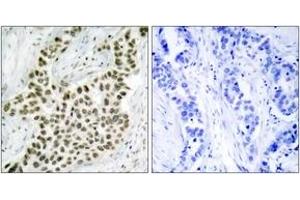 Immunohistochemistry analysis of paraffin-embedded human breast carcinoma tissue, using Histone H2A. (H2AFX anticorps  (AA 94-143))