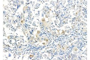 ABIN6264468 and ABIN6277243 at 1/100 staining Human lung cancer by IHC-P.