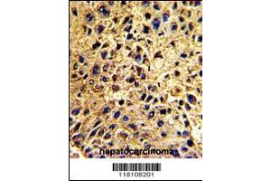 Formalin-fixed and paraffin-embedded human hepatocarcinoma with , which was peroxidase-conjugated to the secondary antibody, followed by DAB staining. (NUP62 anticorps  (C-Term))