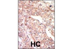 Formalin-fixed and paraffin-embedded human cancer tissue reacted with the primary antibody, which was peroxidase-conjugated to the secondary antibody, followed by AEC staining.
