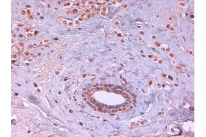 Immunohistochemistry of Rat monoclonal anti AKT2 unconjugated Antibody in human breast carcinoma.