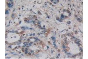 IHC-P analysis of Human Pancreas Tissue, with DAB staining. (Villin 1 anticorps  (AA 1-320))
