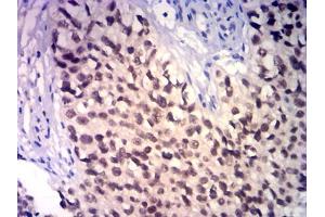Immunohistochemical analysis of paraffin-embedded bladder cancer tissues using GATA3 mouse mAb with DAB staining.