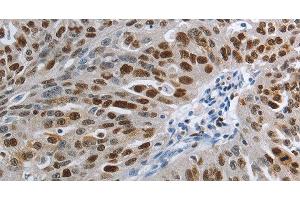 Immunohistochemistry of paraffin-embedded Human ovarian cancer using MCM3 Polyclonal Antibody at dilution of 1:30