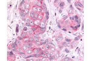 Anti-DUSP22 / JSP 1 antibody IHC of human Colon, Carcinoma. (DUSP22 anticorps  (Internal Region))