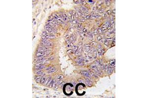 Formalin-fixed and paraffin-embedded human colon carcinoma tissue reacted with PDE8A polyclonal antibody  , which was peroxidase-conjugated to the secondary antibody, followed by DAB staining. (PDE8A anticorps  (Leu572))