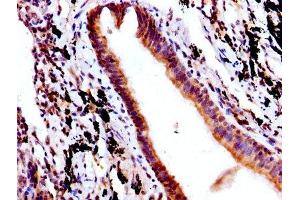 IHC image of ABIN7156043 diluted at 1:500 and staining in paraffin-embedded human lung cancer performed on a Leica BondTM system. (FcRn anticorps  (AA 24-297))