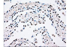 Immunohistochemical staining of paraffin-embedded Adenocarcinoma of breast tissue using anti-PLK1 mouse monoclonal antibody. (PLK1 anticorps)