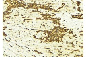 ABIN6269179 at 1/100 staining Human breast cancer tissue by IHC-P. (AFT1 anticorps  (Internal Region))