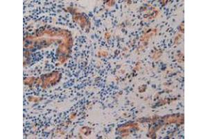 IHC-P analysis of Human Prostate Gland Cancer Tissue, with DAB staining. (Prolactin Receptor anticorps  (AA 25-234))