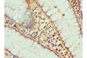 Immunohistochemistry of paraffin-embedded human colon cancer using ABIN7155290 at dilution of 1:100