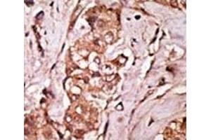 IHC analysis of FFPE human breast carcinoma tissue stained with the LRRK2 antibody (LRRK2 anticorps  (AA 931-962))