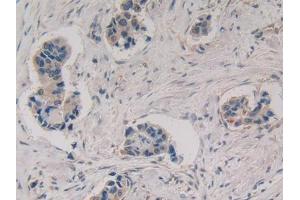 DAB staining on IHC-P; Samples: Human Breast cancer Tissue