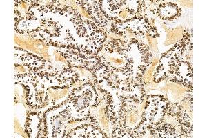 ABIN7095883 and ABIN7099945 at 1/100 staining human ovarian cancer by IHC-P. (PHRF1 anticorps)